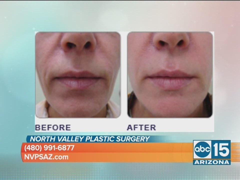 North Valley Plastic Surgery offers new treatment to help facial aging