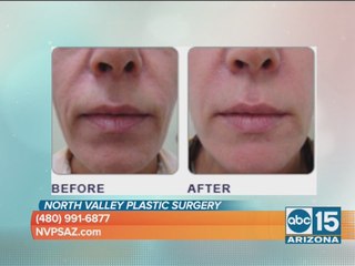 North Valley Plastic Surgery offers new treatment to help facial aging