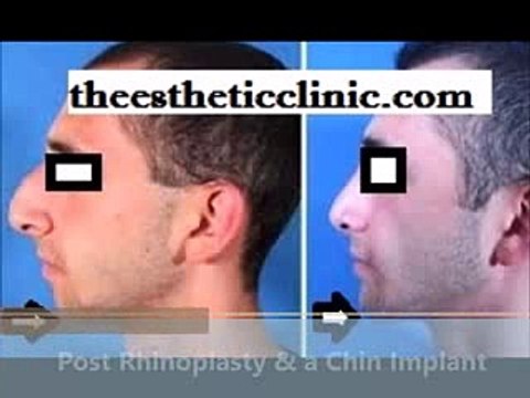 Chin Implant and Augmentation at Facial Plastic Surgeon India