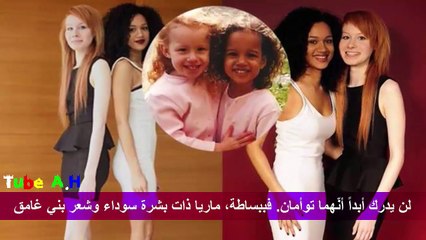 اغرب حالات التوائم لن تصدق انهم موجودين 1993