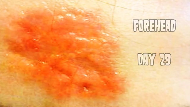 Elle veut traiter son cancer de la peau avec une pommade à base de plantes: C'est l'horreur