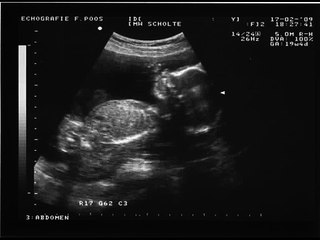 Hartje Lars 24 weken