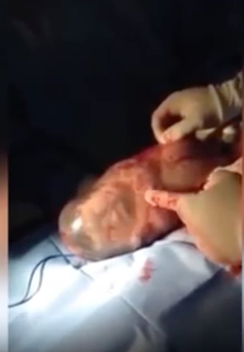 Extraordinary Video of Baby born inside its amniotic sac