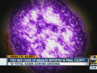 Two new cases of measles reported in Pinal County