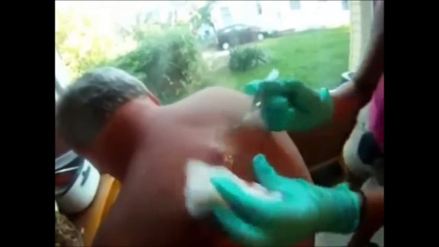 Il a cette grosse bosse sur le depuis des années, son ami la perce enfin et ce qui sort de là? OH MON DIEU!