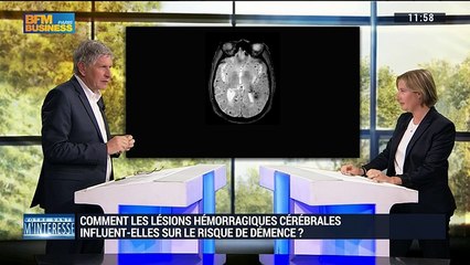 Comment les lésions hémorragiques cérébrales influent-elles sur le risque de démence ?- 04/06