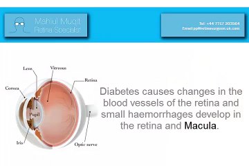 Diabetic Eye Disease