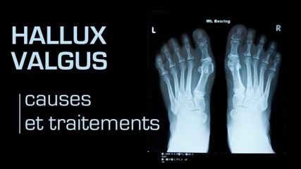 Que faire en cas d’hallux valgus ?