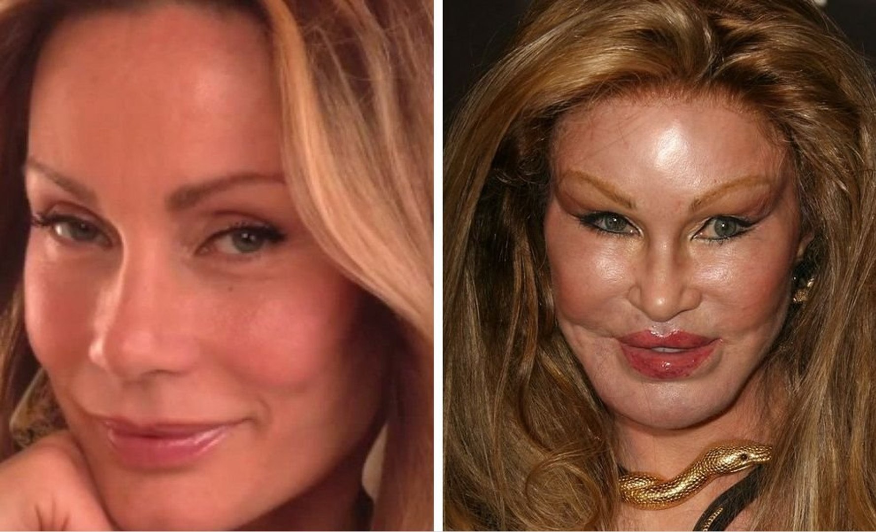 Plastic Surgery Disasters Before And After