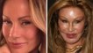 Worst Cases of Celebrity Plastic Surgery Gone Wrong -- Before-And-After Plastic Surgery Disasters