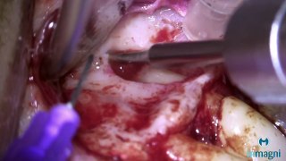 Cirurgia parendodôntica   endodontia cirúrgica + MTA   Dente 25