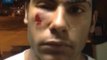 Jovem é atingido por estilhaço nas manifestações em Brasília