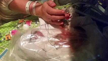 Pour sauver la vie de ces  jumeaux partageant le même placenta, les médecins en retirent un à 23 semaines de grossesse !