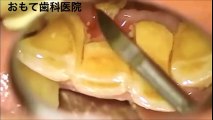 Plaque calcite removal extraction (tartar) - dentist dental surgery