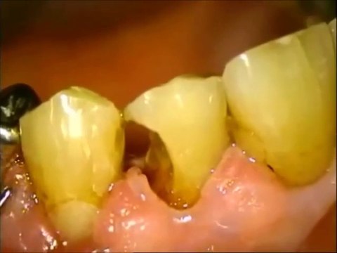 Tooth decay repair, filling, dental repair, massive hole, long overdue