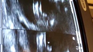 Baby Hagman Ultrasound