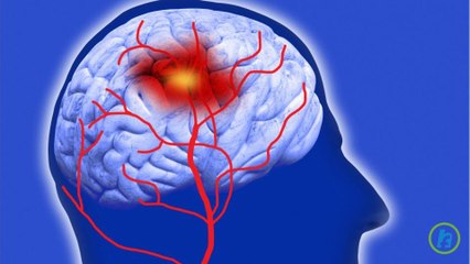 What are Strokes? FAST Facts on How to Prevent, Treat, and Manage A Stroke