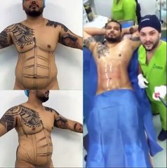 De la chiurgie pour avoir des abdos