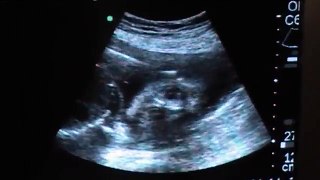 Jackson's 25 week ultrasound
