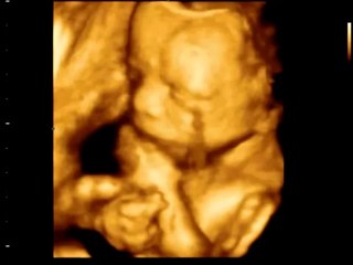 4D УЗИ плода 26 недель беременности