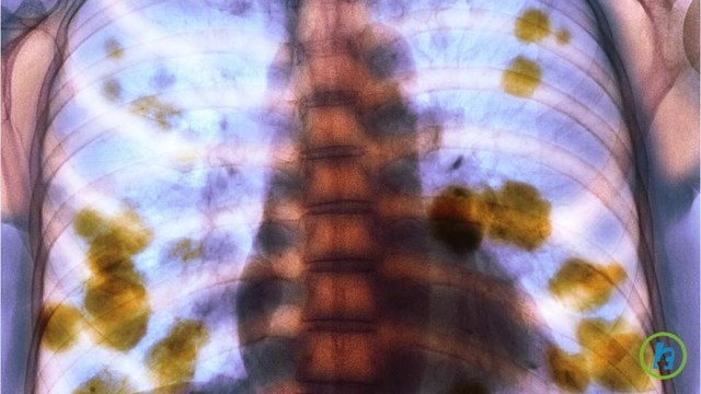Lung Cancer Risk Patients Increase Life Expectancy With Early And Frequent Screening