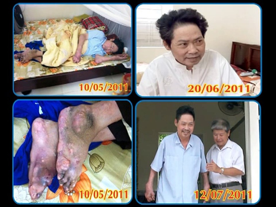 Cách điều trị bệnh gút hiệu quả - Phòng khám đa khoa Viên Gút