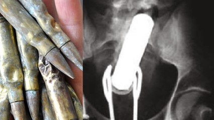 Top 10 Strangest Things Found in X-Rays