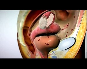 Endometriosis Treatment In Bangalore