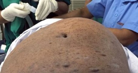 Hindistanlı Kadının Karnından 7 Kg Ağırlığında Tümör Çıkarıldı