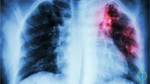 How to Prevent, Treat, and Manage Pulmonary Tuberculosis?