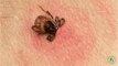 Symptoms of Lyme Disease