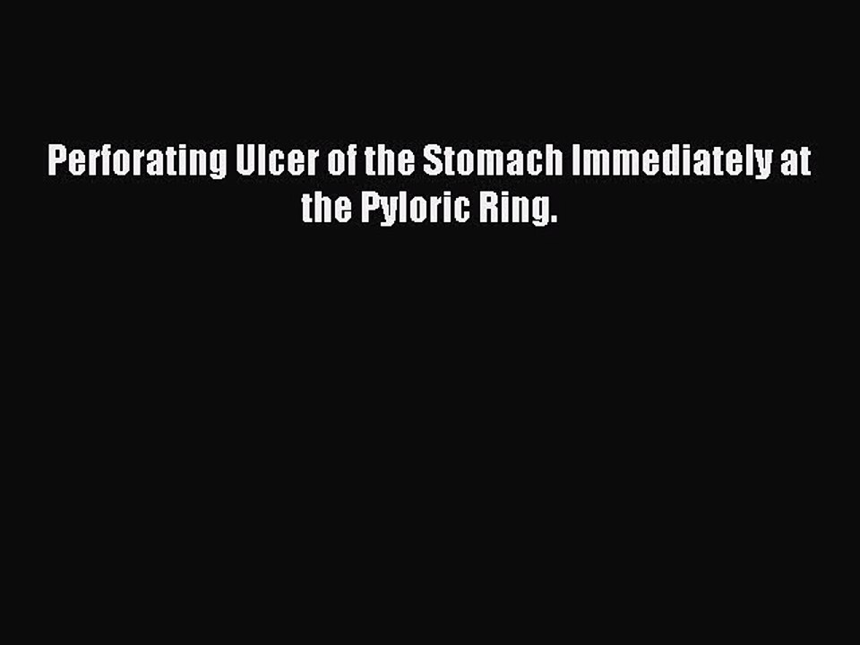 Download Perforating Ulcer of the Stomach Immediately at the Pyloric Ring. PDF Online