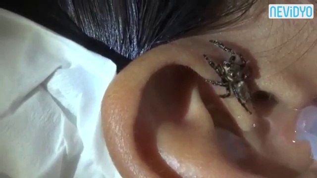 Kulağa kaçan örümcek nasıl çıkarılır