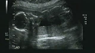 Craig Jr. Baby Boy ultrasound 19 weeks