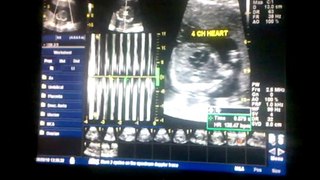 Sarahs Ultrasound video-2010-08-09-13-29-09