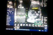 Sarahs Ultrasound video-2010-08-09-13-29-09