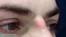 Dr Nick remove a huge cyst from a man's nose