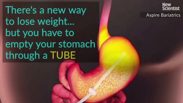 Obésité: Perdre 20 kilos en un an, c'est possible grâce au robinet à estomac !