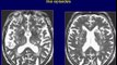 Neuroradiology Case 26