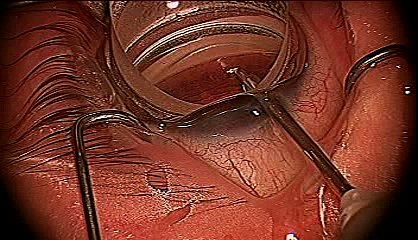 Dr. Francis Trabectome Surgery (3:28 min)