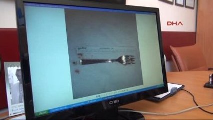 Konya Yuttuğu 15 Santimlik Metal Çatal, Ameliyatla Midesinden Çıkarıldı