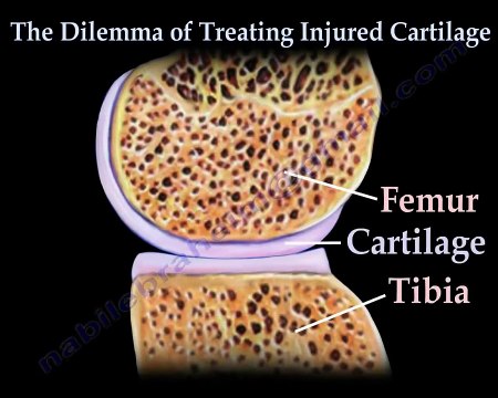 Knee pain arthritis and Injured Cartilage - Everything You Need To Know - Dr Nabil Ebraheim M D