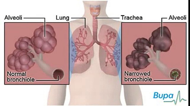 Tác hại thuốc lá - cách cai nghiện thuốc lá với SINGUM ZOFT HALT (24 VIÊN) có tại zex.vn