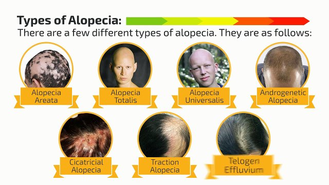Alopecia - An Overview To The Severe Hair Loss Problem