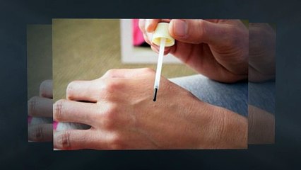 Plantar Wart Removal