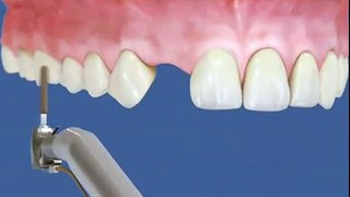 Восстановление зубов при помощи металлокерамики