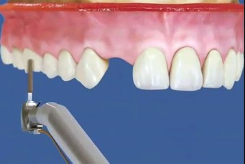 Восстановление зубов при помощи металлокерамики