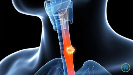 What is Esophageal cancer?