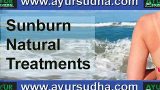 Sunburn Natural Treatments