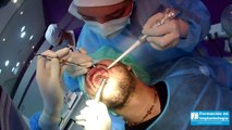 Cursos Implantología - Plasma Rico en plaquetas Implante 24,36 - Cursos Implantes
